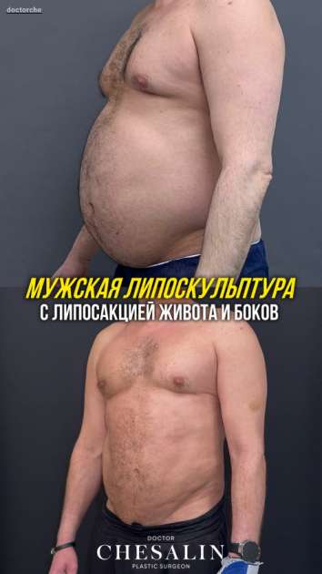 Мужская липосакция живота и боков с результатом до и после