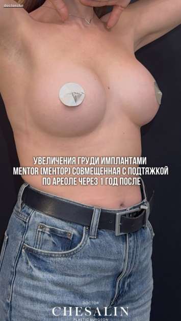 Увеличение груди имплантами MENTOR (МЕНТОР), совмещенное с подтяжкой по ареоле: через 1 год после с видео-результатом
