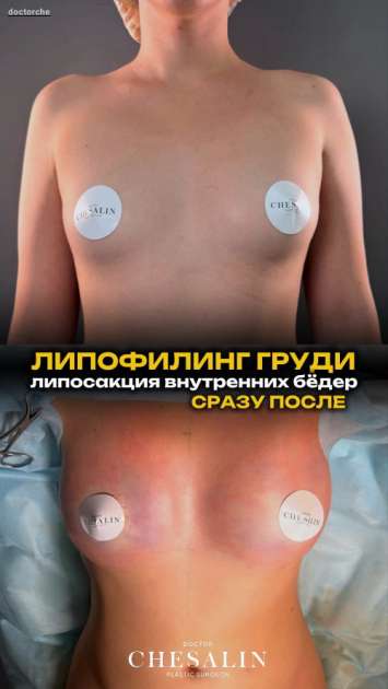 Липофилинг груди и липосакция внутренних бедер: до и результат сразу после с фото и видео