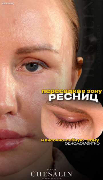 Пересадка ресниц и волос в височно-лобную зону (фото и видео). Нюансы процедуры