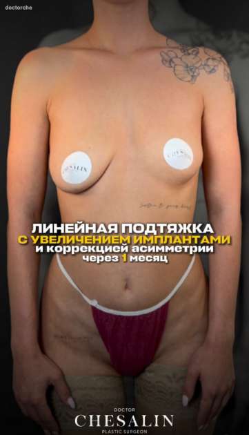 Линейная подтяжка с увеличением имплантами и коррекцией асимметрии через 1 месяц с фото- и видео-результатом