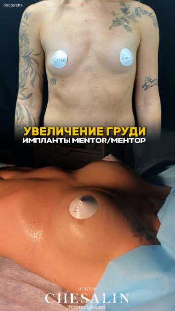 Увеличение груди имплантами MENTOR / МЕНТОР: до и сразу после операции с фото и видео-результатом